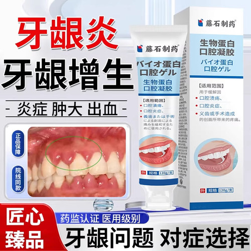 牙龈增生息肉肿痛肥大凝胶