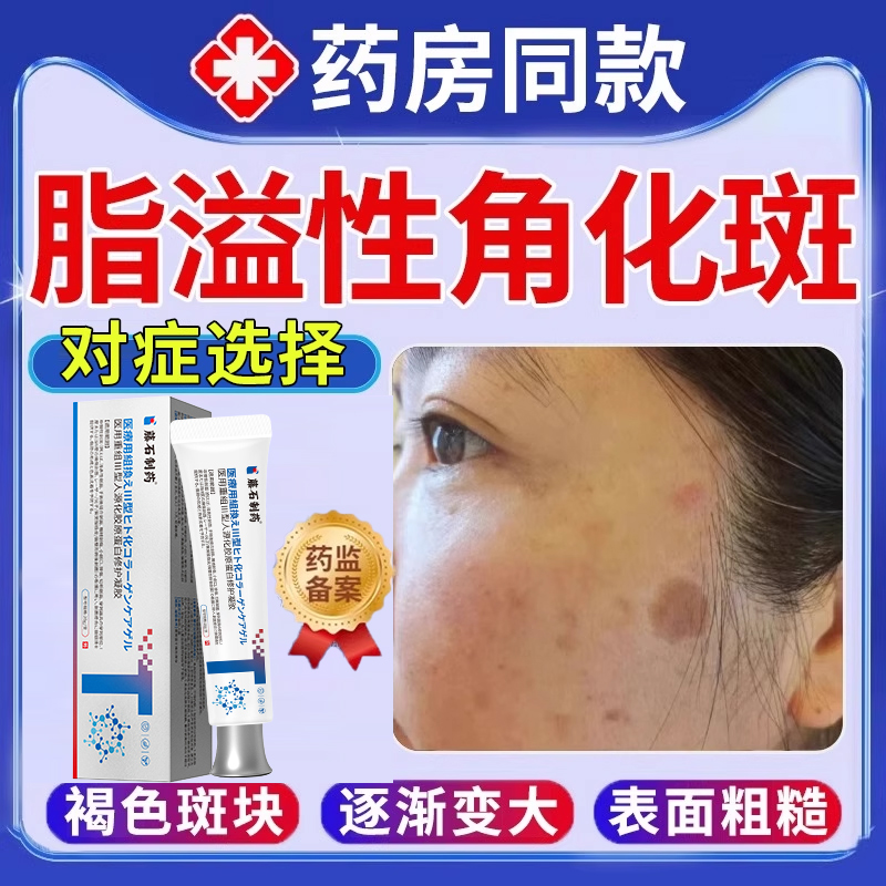 藤石制药脂溢性角化斑去老年斑