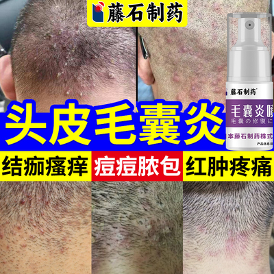毛囊炎后脑勺长脓包红肿疙瘩