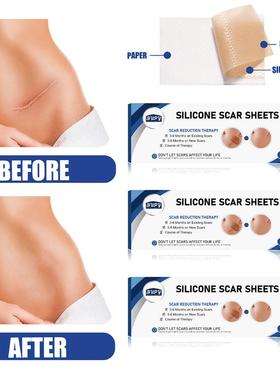 Scars from sticky scars and silicone gel fixes C-section inv