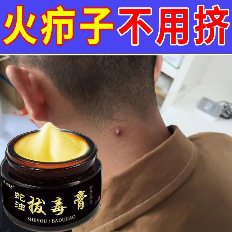 火疖子拔毒膏红疙瘩屁股红肿硬块坐板疮流脓包痘痘毛囊拔毒去脓水