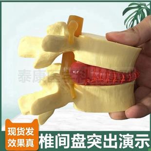 人体腰椎模型椎间盘脊髓神经椎骨劳G损病理突出演示疏松骨密质