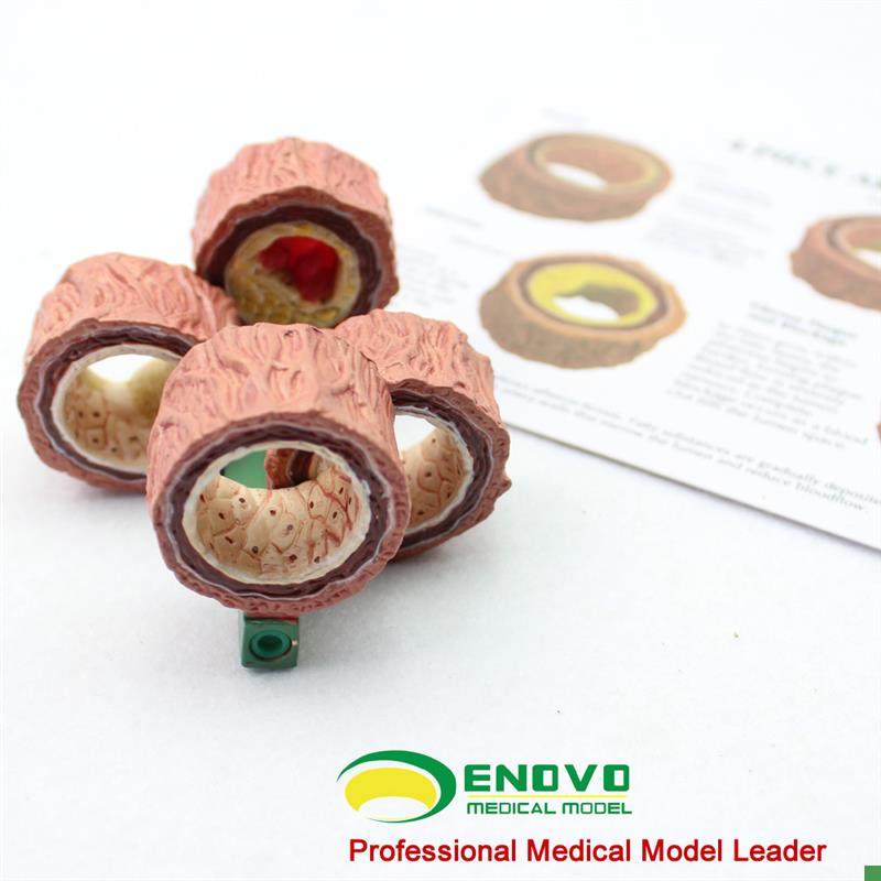 颐诺正品动脉粥样硬化模型血C栓病变模型心血管模型内科学