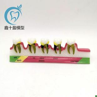 牙科口腔教学演示模型龋齿x牙周根管医患沟通牙周分类模型M8