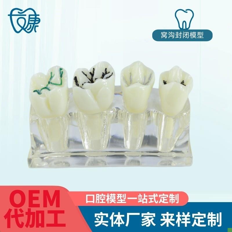 透明窝沟封闭模型牙科口s腔教学牙模种植修复病理模型牙齿模型厂