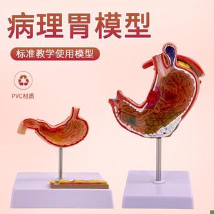 病理胃仿真人体胃的穿孔病态胃消化科胃L冠状剖面解剖放大模型