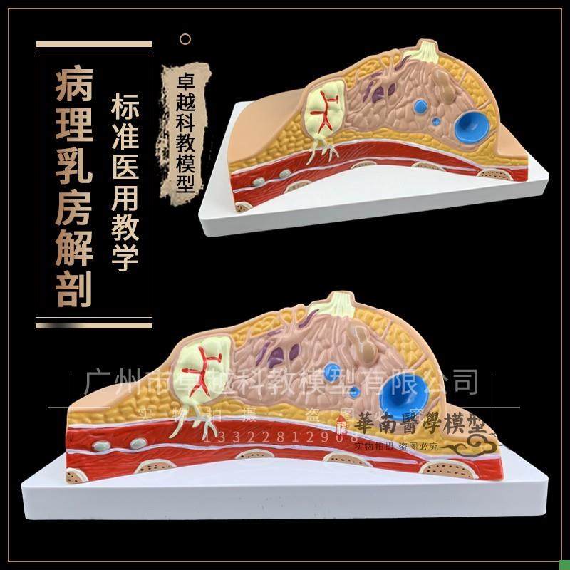 包邮教学病理乳房模型乳腺病变模型乳房H解剖模型人体乳房素描标