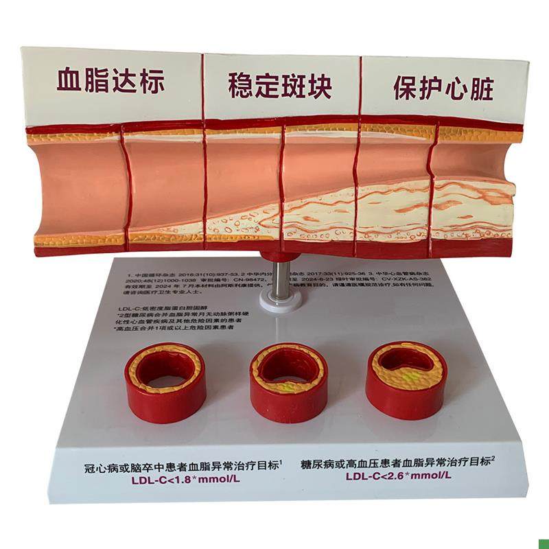 血管活动堵塞动支脉粥样硬化心血管动脉硬K化模型血管病理模型血
