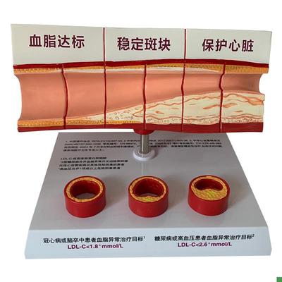 血管活动堵塞动支脉粥样硬化心血管动脉硬K化模型血管病理模型血