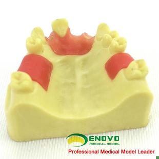 ENOVO颐诺上颌缺失种植实训模型口G腔即刻种植操作上颌骨缺失牙齿