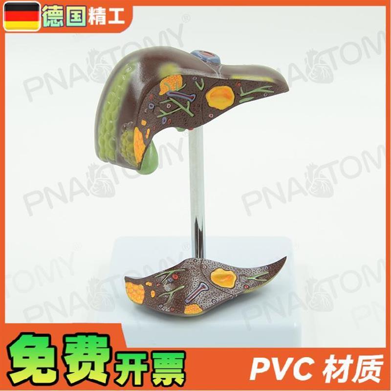 德国仿真医学病理肝脏解剖模型抽烟肝H消化科教学标本肝胆保健模