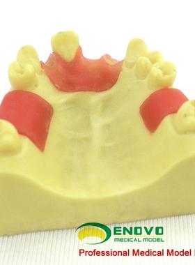 ENOVO颐诺口腔上z颌缺失牙种植操作训练模型