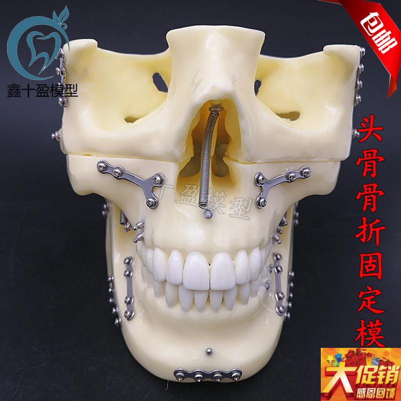 牙科种植支抗钉模型n 头颅骨折固定模型 头颅骨口腔模型医学教学