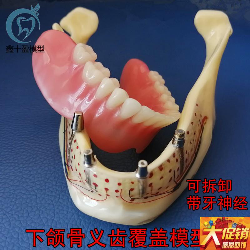 牙科口腔下颌骨展示模型 透明下颌骨展示种植钉 义齿修复Y模型600