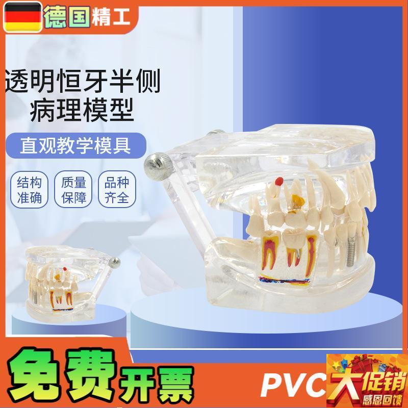 德国透明恒牙半侧病理模型 综合病理牙模型可拆卸牙模Z种植体修复