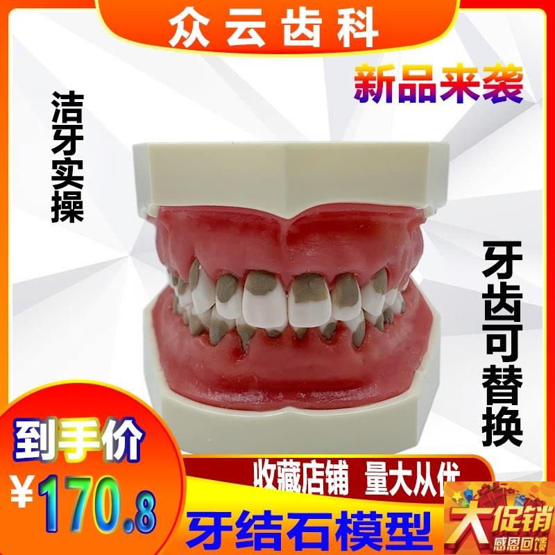牙科口腔练习牙结石龈上龈下刮治A模型 牙结石牙周 病理牙齿模型