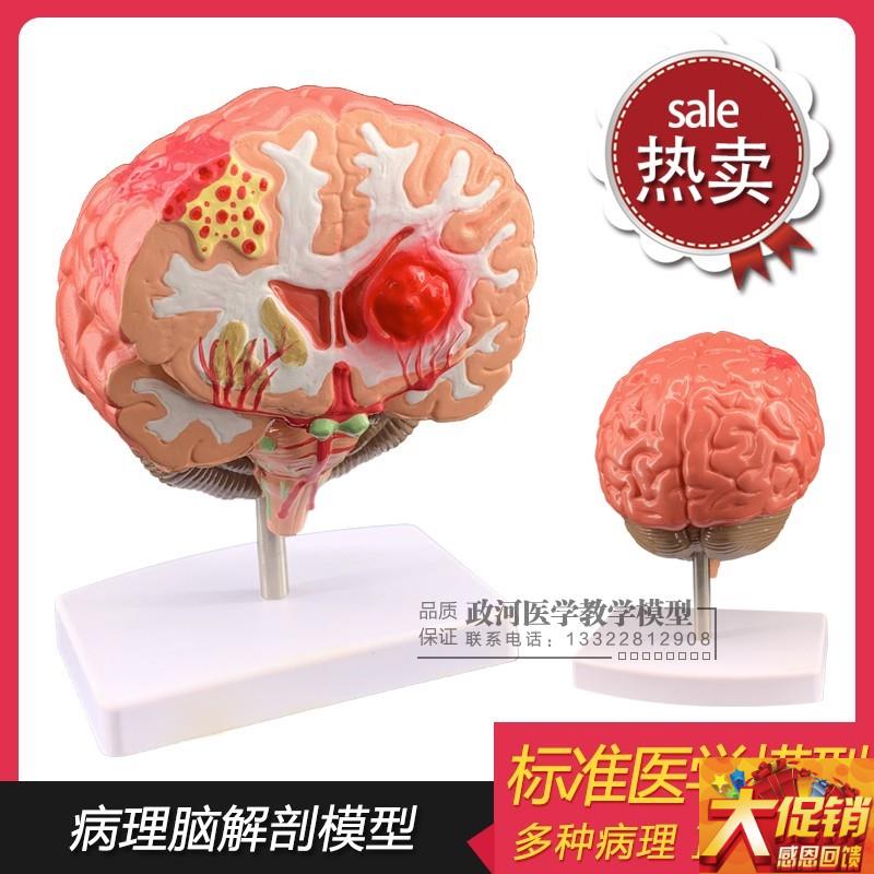 仿真人体脑部疾病模型 大脑解剖 神经内I外科 脑病理 大脑病变模