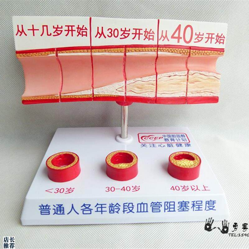 人体支脉粥样硬化和血栓y形成模型人体模型病态血管模型