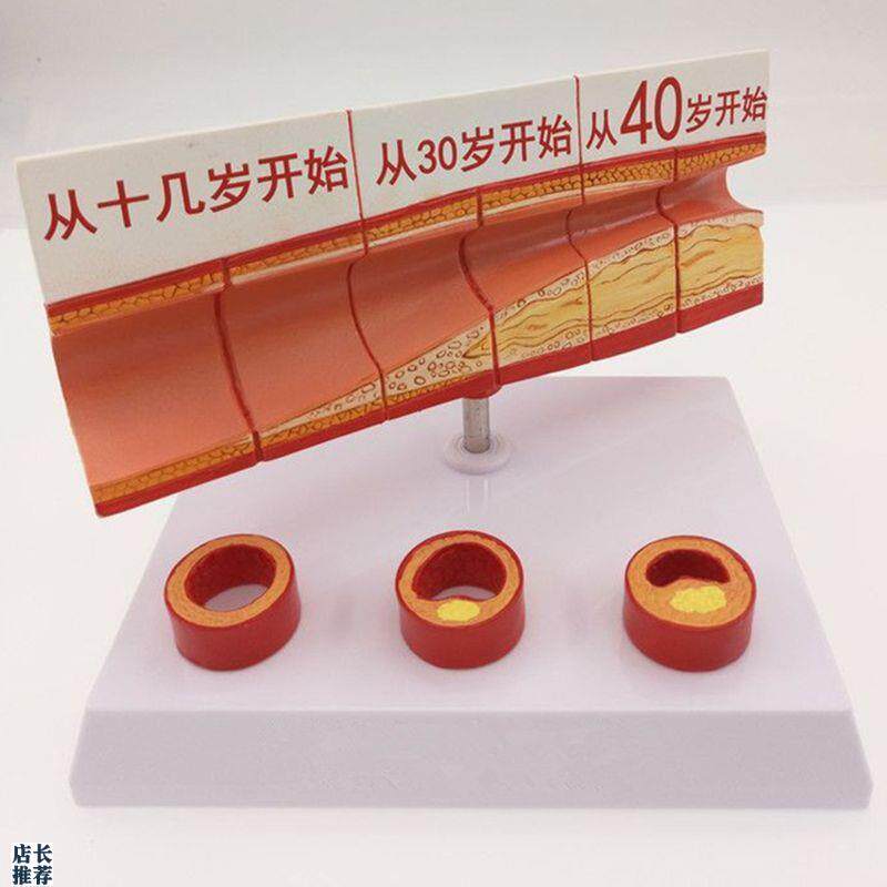 动脉血管模型不同年龄段血管内膜变化粥样硬化栓子Y血管狭窄斑块