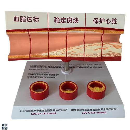 人体血管斑块狭窄粥样硬u化心血管动脉硬化模型血栓人体教学