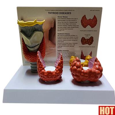 状腺解剖模K型甲状腺结节甲状腺肿桥本甲状腺炎乳突癌教学人体