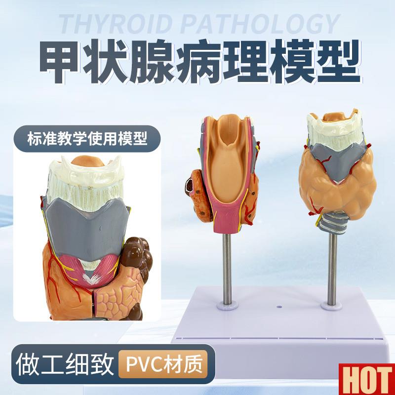 学仿真人体甲状腺病理模型喉头解剖甲状腺留甲状腺a囊肿标本教具