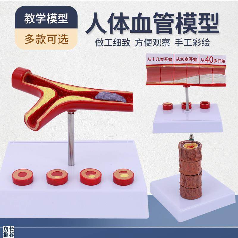 血管/堵塞d动支脉粥样/硬化心血管动脉/硬化模型血管病理模型血栓