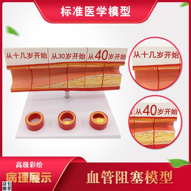 人体血管模型动脉血管阻塞变w化演示教学模型器官解剖结构层次模