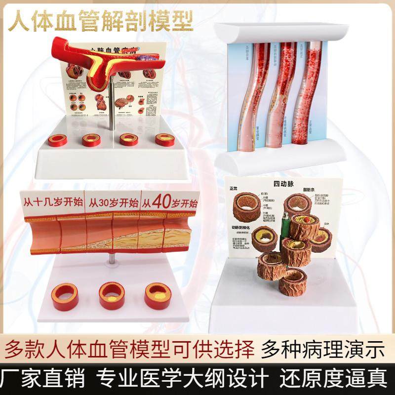 血管堵塞动d支脉粥样硬化心血管动脉硬化模型血管病理动态血栓模