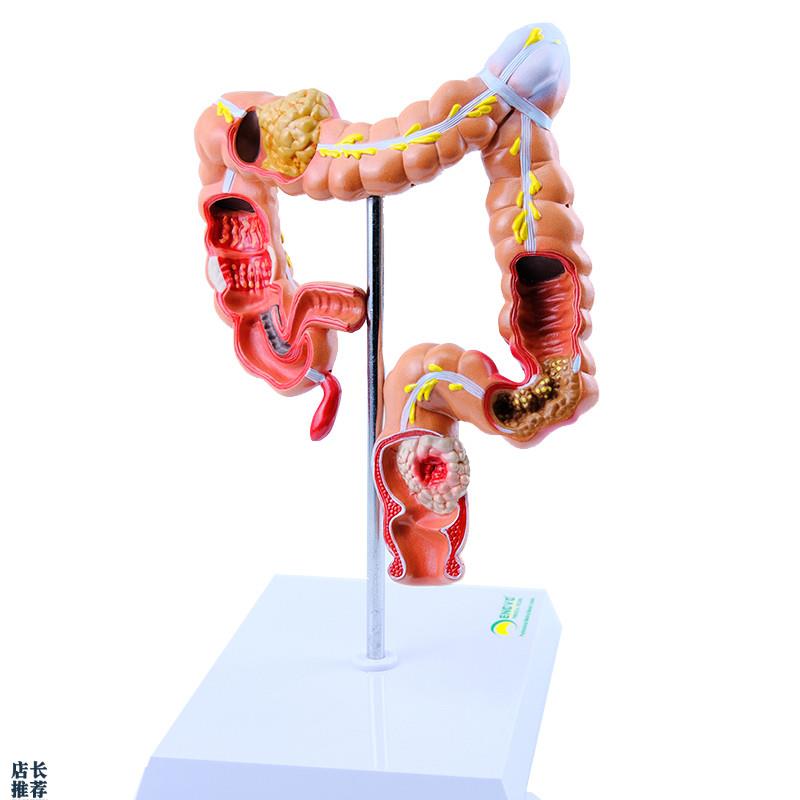 ENOVO颐诺人体大肠疾病展示模型结肠直肠L道病变症状消化系统疾病