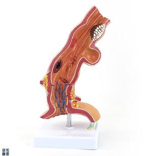 ENOVOc颐诺人体食管疾病理模型医院消化科教学医患沟通解剖模型食
