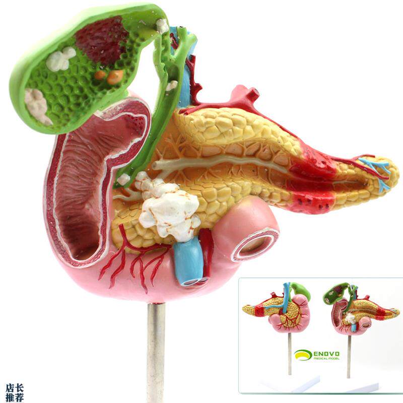 ENOVO颐诺医学胰腺十二指肠胆B囊病理模型外科消化科系统模具肝胆