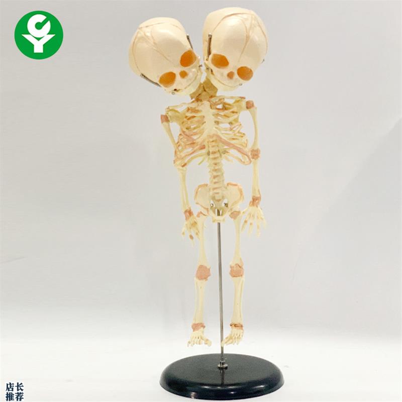 人体婴儿骨骼模型双头胎s儿头骨畸形婴儿人骨架演示教具胎儿头骨