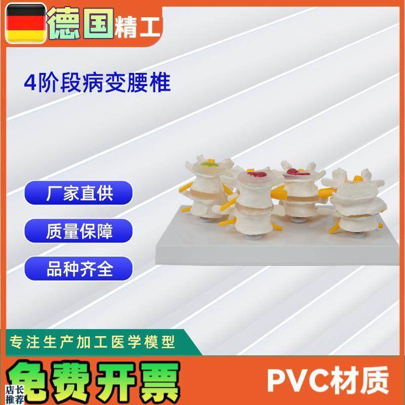 德国】人体4阶段病态腰椎v比较模型人体骨骼模型医学教学教具