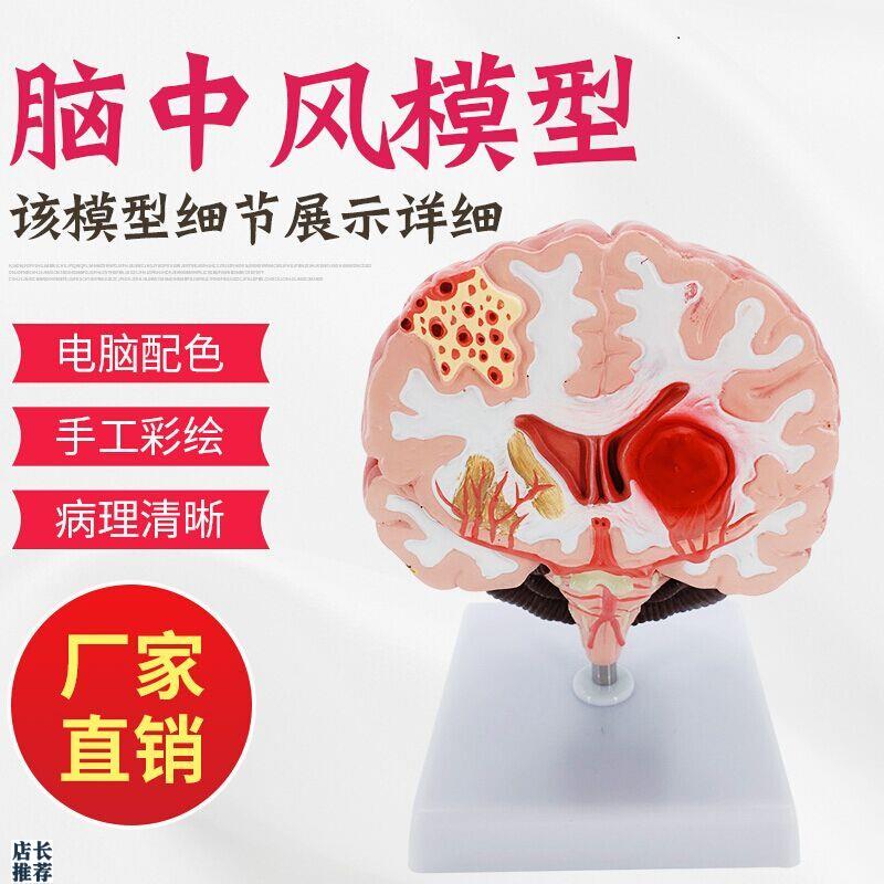 人体脑解剖脑病理疾病脑病理构F造脑(血管)病变脑模型