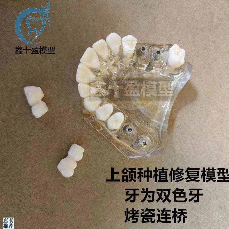 牙科种植模型2011上颌种植解说E义齿修复烤瓷连桥种植钉模型