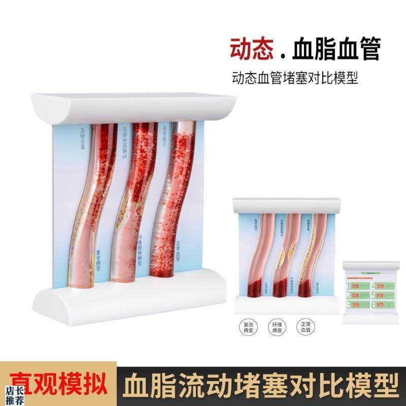 血管浓稠度d堵塞对比人体血脂斑块血栓展示模具仿真动态血管模型