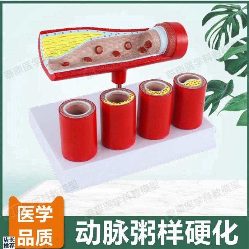动脉血管模型内膜j粥样斑块阻塞狭窄硬化医患药礼品血管壁层次解