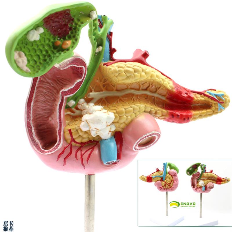 ENOVO颐诺医学胰腺十二指肠胆A囊病理模型外科消化科系统模具肝胆