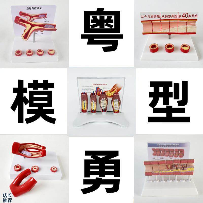 动态血管粘稠堵塞模型动支脉粥样硬化G心血管支架放大病理教学模
