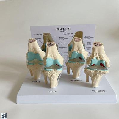 人体膝关节模型半月板损伤软x骨磨损骨赘年龄段膝盖变化韧带医患