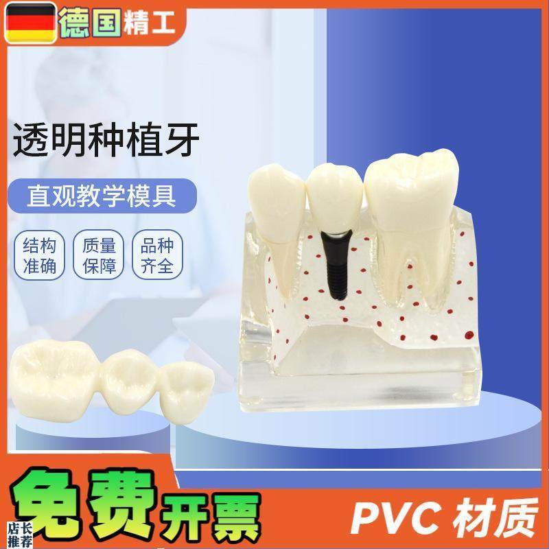 德国】透明种植牙模型牙科修复模型透明可R拆卸病理种植体牙