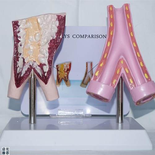吸烟血管a与正常血管比较模型人体血管病理展示医用教学讲解教具