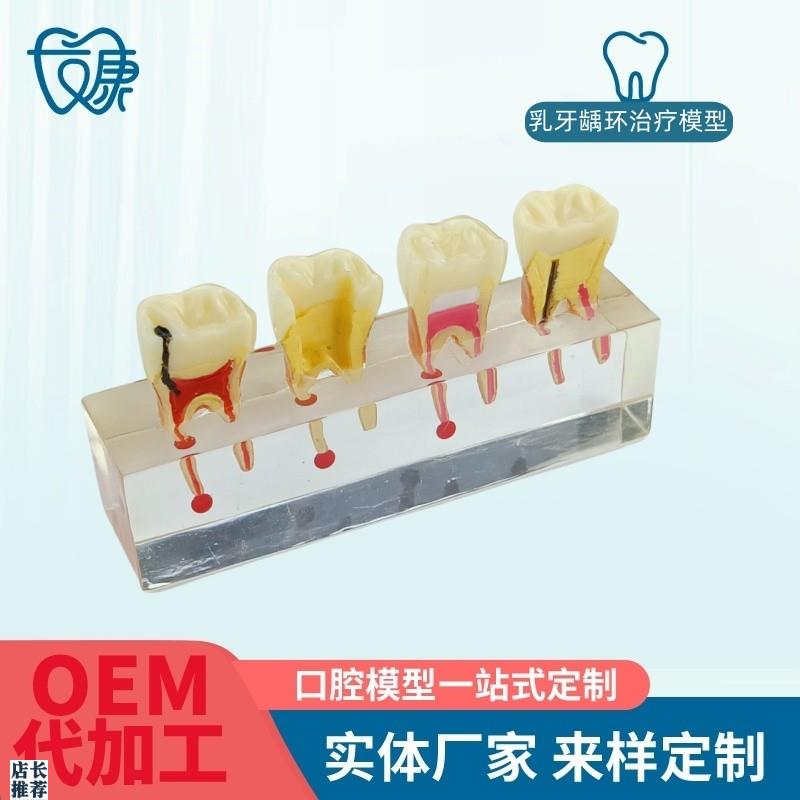 根管牙髓治疗模型牙科口腔教学牙模种植K修复病理模型医患沟通模