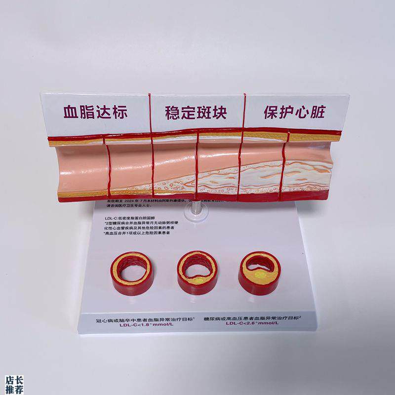 病理心血管模型粥样硬化脂u肪斑块动脉内膜受损程度医药促销礼品