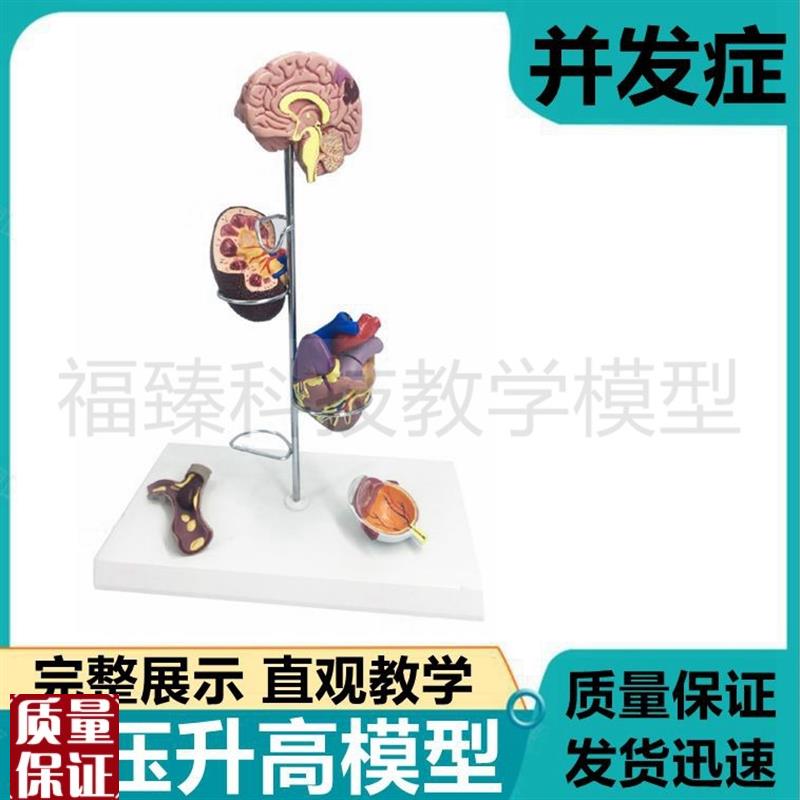 动脉血管压力f升高模型脏器受损并发脑心脏血管眼底肾脏血液循
