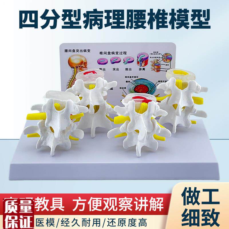 四分型病变腰椎与正q常腰椎组合模型人体骨骼病理骨骼模