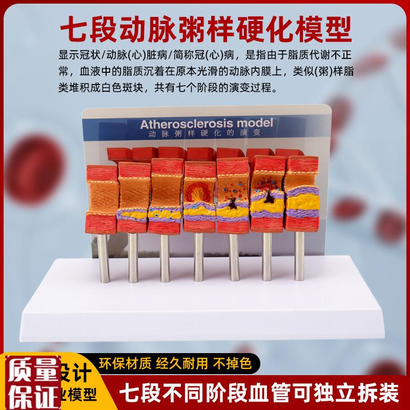 人体心脑血管动脉粥样硬化堵塞模型F血栓血液脂肪病理解剖医学教