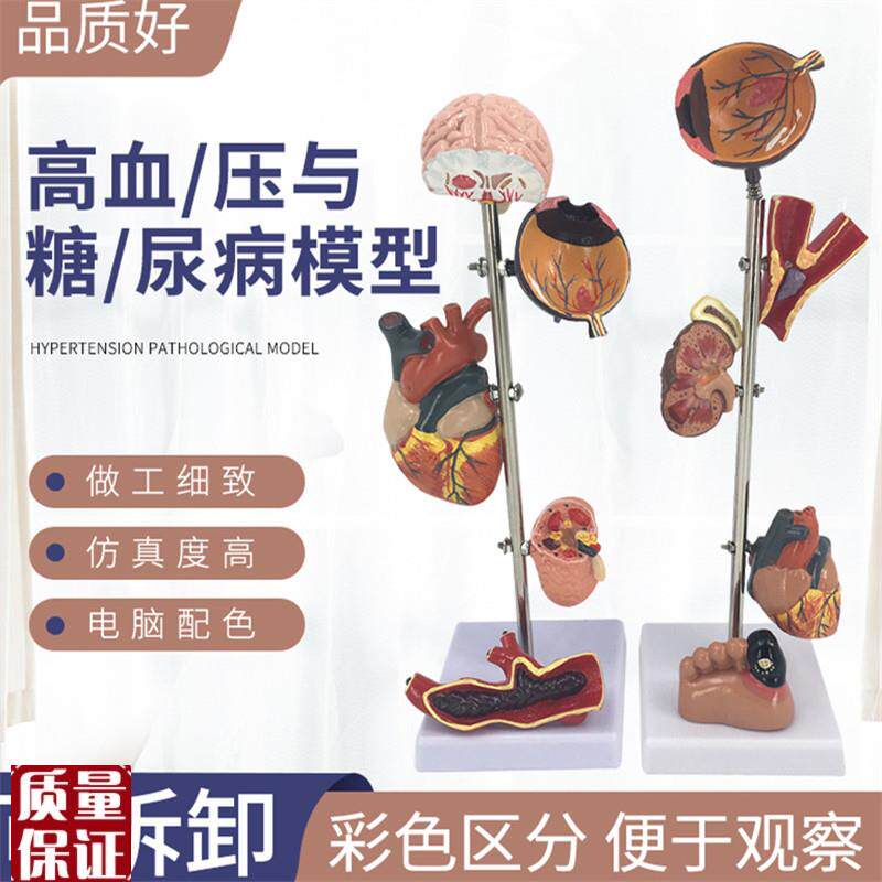 糖尿病靶器官模型糖尿病并发症N模型高血压病理模