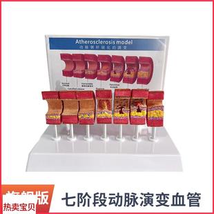 动脉粥样硬化模型血管血栓栓塞模型动H脉血管人体医用医学教学教